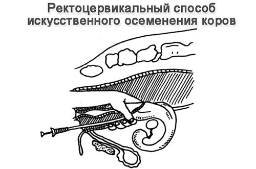 Ректоцервикальный способ